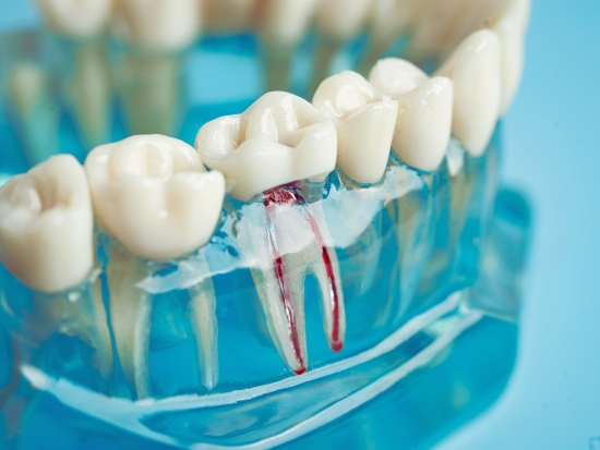 does root canal surgery hurt