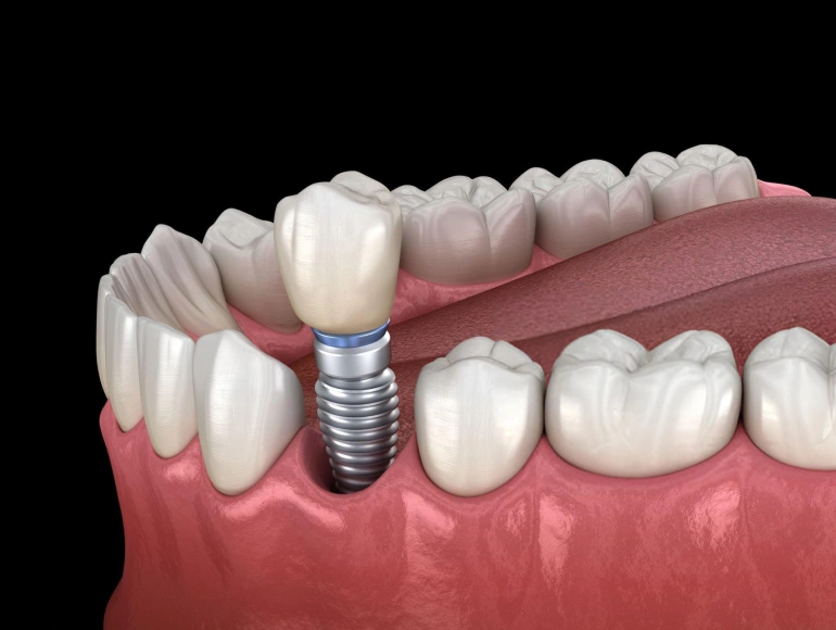 advanced dental implant technologies at city edge dental